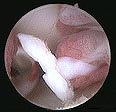 Arthroscopy