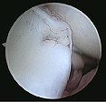 Arthroscopy