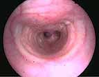 Bronchoscopy