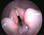 Bronchoscopy