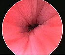 Cystoscopy