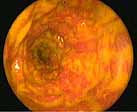 Gastrointestinal Endoscopy
