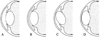 Drawing illustrating the different types of anterior lens luxation