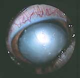 Luxated lens with cataract