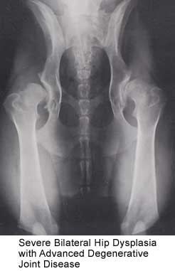 Severe Bilateral Hip Dysplasia with Advanced Degenerative Joint Disease