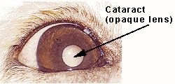 Eye with Cataract