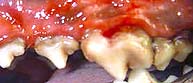 Advanced Periodontitis