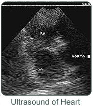 Ultrasound of the Heart