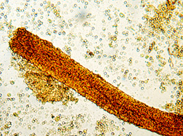 Urinary Cast